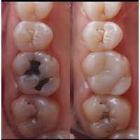 Teeth filling in kampala 